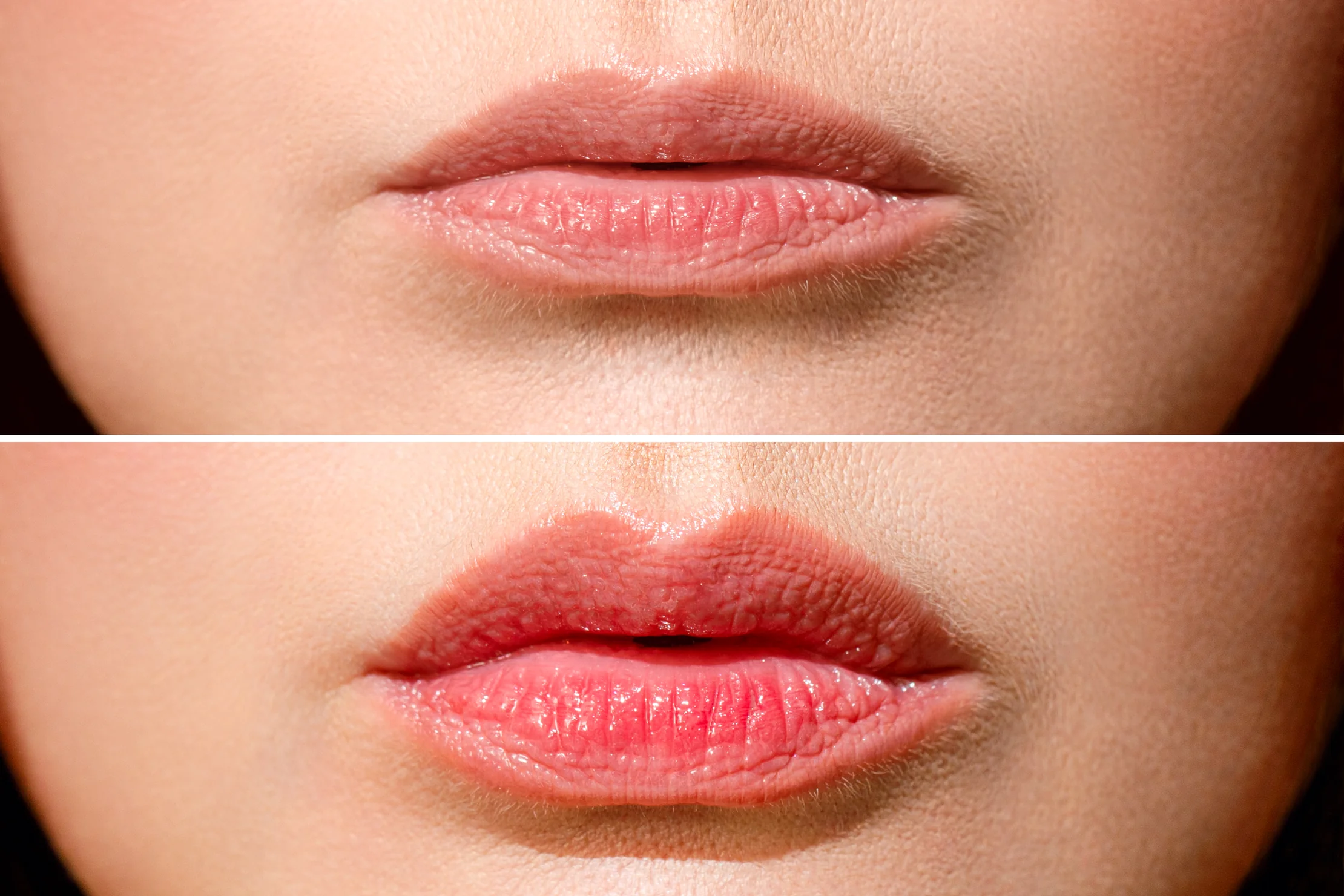 ridicare buze lip lift rentea bucuresti (3)
